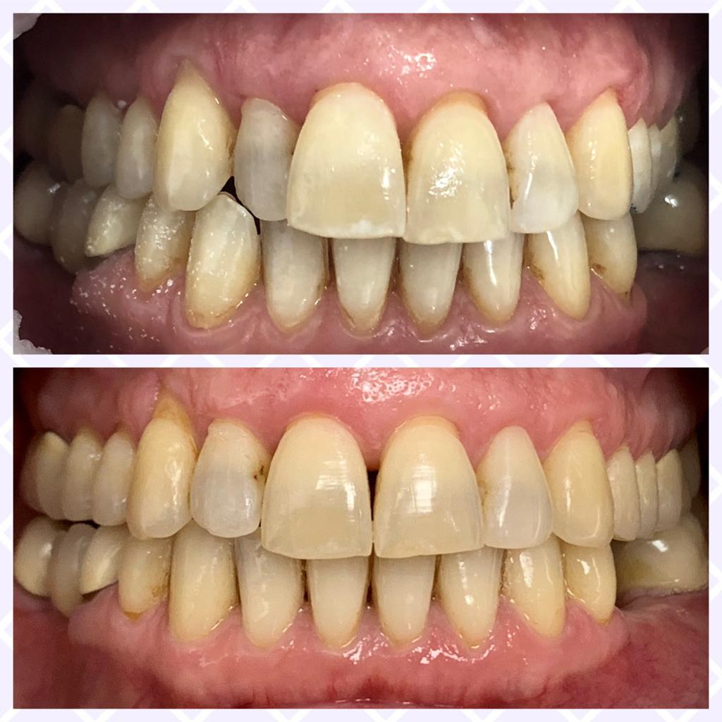 Cas invisalign