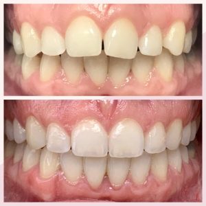 Cas invisalign