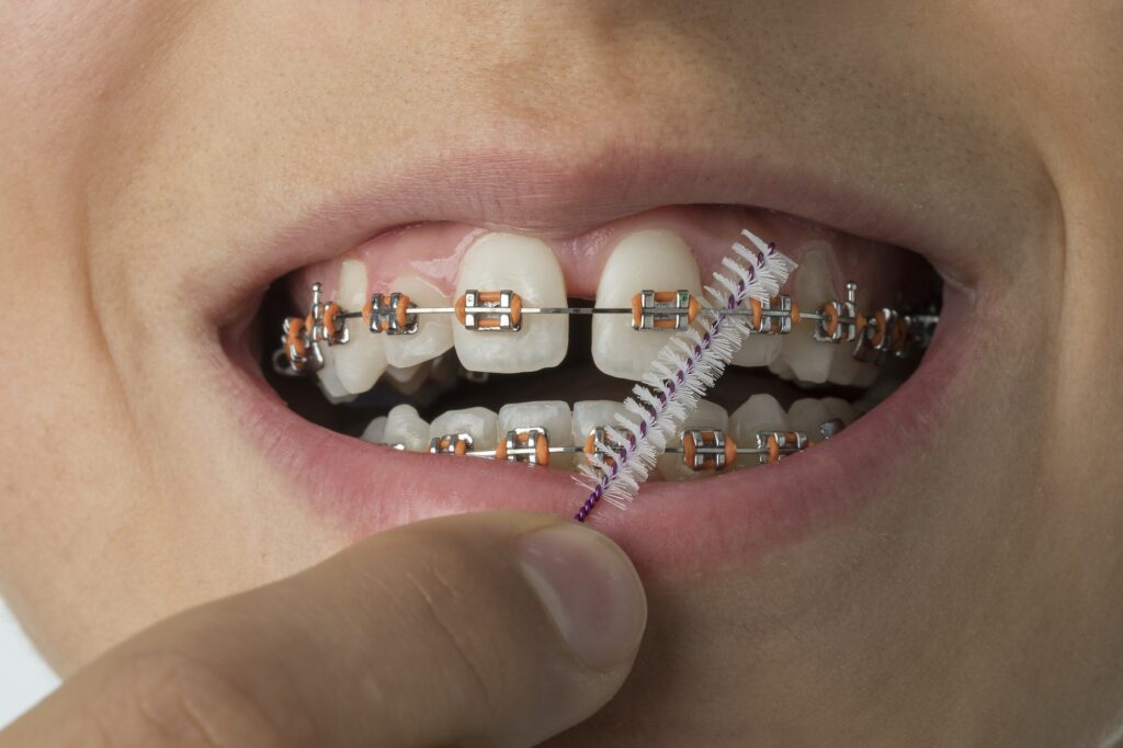 Close up of cleaning dental braces