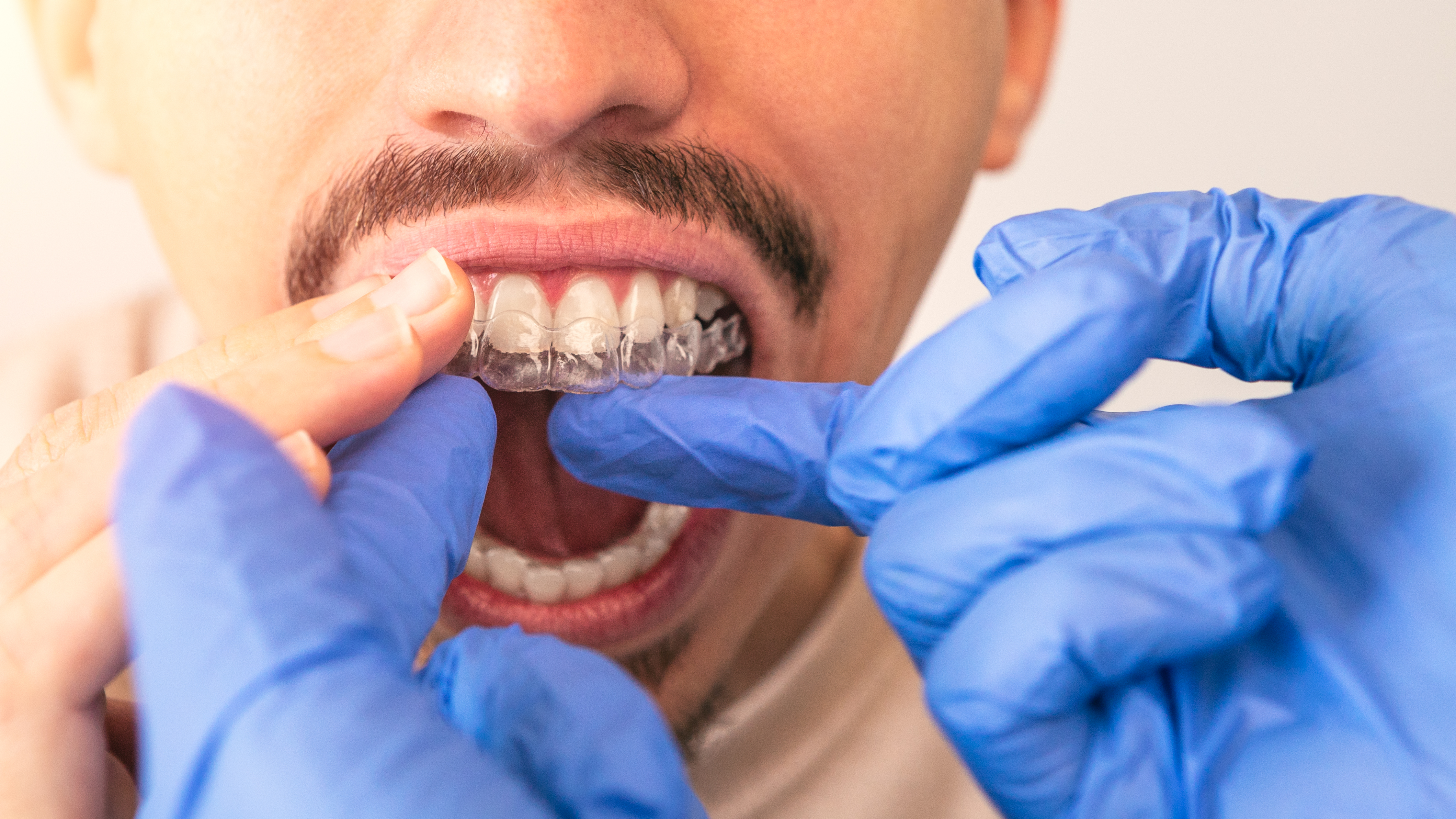 Orthodontist doctor putting silicone invisible transparent braces on man's teeth